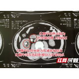 男子被结石困扰十几年 肾结石患者需注意定期进行检查