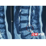 23岁小伙突然腿麻抽筋 腰椎间盘突出年轻化趋势值得注意