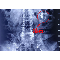 70岁娭毑患上结石霸蛮忍 肾脏长满结石