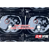 女子把结石当小病不在意 未料胆囊竟被结石塞满引发更大危机