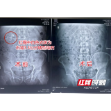 货运司机长期久坐、喝水少惹上结石 拖延多年爆发双肾危机