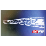 湖南省中医院：手指无外伤却“一碰就痛”？ 警惕这种肿瘤