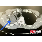 肺部一鸡蛋大小空洞里长满黑褐色真菌 47岁男子咳血不断生命危在旦夕
