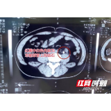 女子腰部持续剧痛8小时 实在“难忍”才就医险酿大祸
