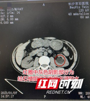 货运司机常年喝水少、爱憋尿 偶然体检才知结石引发尿路梗阻