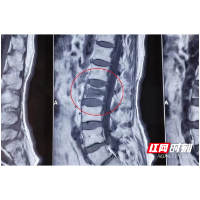 娭毑一跤摔出压缩性骨折 南湖妙手解病痛