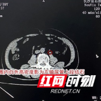 工作繁忙无暇喝水 男子突发尿血急就医才知双侧尿路被堵