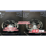 男子频繁腰痛不当回事 直至尿不出就医才知双侧尿路梗阻