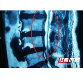 伤腰9月瘦15斤 拯救他的竟是一个6mm小孔