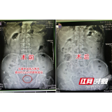 七旬老人突发尿血家人误以为患癌 不料竟是膀胱中结石所致