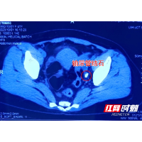 女子误把“结石”当感冒 双节假期医院过