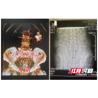 老人患结石因不痛一直任性不管 不想左肾竟长出7厘米巨石