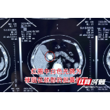 长沙一老人腹痛6小时紧急就医 最终保胆取出颗3.3厘米“大卤蛋”