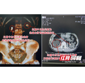 男子一年前查出结石不上心 如今右肾重度积水致肾脏逐渐萎缩