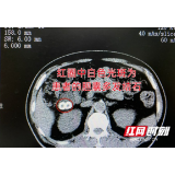 高龄嗲嗲患结石慕名赶到京石医院 超微创技术助其如愿保胆取石
