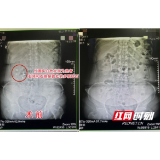 娭毑结石频发却坚持保守治疗 腰痛不止就医方知右肾岌岌可危