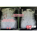 结石老病号病痛发作半月不理 剧痛就医诊断为尿源性脓毒血症