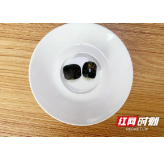 女子患结石花万元买“溶石神药” 谁想结石不小反大险塞满胆囊