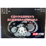 女子连续两月腰痛未理 直至尿血就医方知左肾功能已危在旦夕