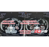 男子体检查出结石漠视不管 而今腰痛就医发现双肾险受损