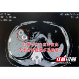 一顿油腻晚餐引爆胆囊结石 男子就医保胆取出两颗“大卤蛋”