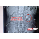 男子患结石十余年没在意 结果左肾养出个3cm“大香菇”