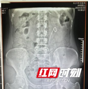 女子患结石偶有腰胀未在意 直至小便颜色深如可乐才觉不妙