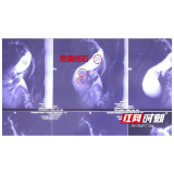 女子禁不住烤串诱惑 引起胆囊结石合并胆囊炎