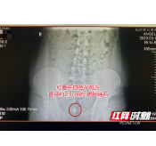 17岁男生尿痛到晕厥 一查发现膀胱竟藏了颗枇杷状大结石
