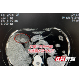 女子患胆囊结石拖延8年不在意 结果小结石变成“大杨梅”