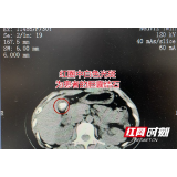 女子为减肥一年只吃素 突发腹痛才知胆囊养出2颗“枇杷籽”