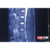 36岁白领久坐伤腰 椎间孔镜6天去病痛