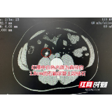 七尺男儿腰痛到满地打滚 就医才知是蚕豆大结石卡住输尿管