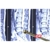 程序员腿麻举步维艰 椎间孔镜6mm小孔快速解决病痛