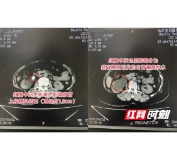 娭毑左腰突发剧痛就医 不料右肾惊现肾脏危机吓坏家人