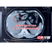 姐弟三人同患胆囊结石 病因或与这个生活饮食习惯有关