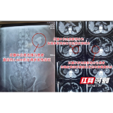 男子多次尿血却从未在意 偶然就医检查才知肾脏藏“大家伙”