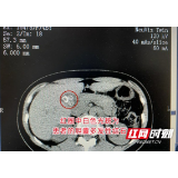 女子胆囊一颗小结石不当回事 拖延6年竟取出一堆“石子山”