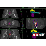 岳阳市中心医院成功实施宫颈癌3D打印技术联合无痛三维插植后装放疗