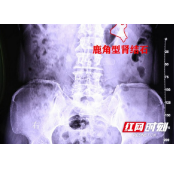 长沙女子患结石 盲目服用“网红消石药”致肾脏积脓