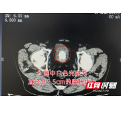 嗲嗲尿频尿急3年不以为意 今症状加剧就医膀胱竟长鸡蛋大结石