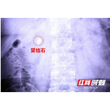 女子肾结石堵塞尿路 执意“碎石”被阻