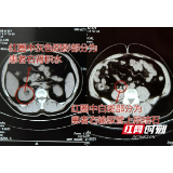 男子常年用浓茶代替白开水今腰腹剧痛入院查出花生大结石