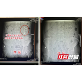 男子患肾结石十多年未理 今反复血尿才知左肾险被巨石撑满