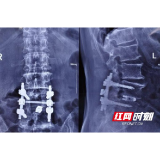 腰疼7年一步难动 帮他的竟是4颗钉子......
