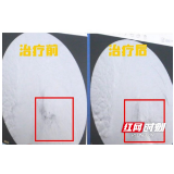 长沙珂信肿瘤医院：用DSA技术给肿瘤“断粮” 为更多患者带来转机