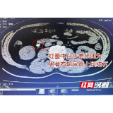 男子酷爱打牌常久坐憋尿 不料豌豆大结石堵住尿路引发剧痛