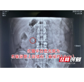 男子尿液颜色变红却不在意 腰痛加剧就医才知是结石在作怪