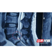 久坐久站诱腰突 椎间孔镜轻松解除4年病痛