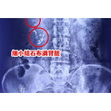 女子结石如“满天星”长满肾脏 竟是“海绵肾”
